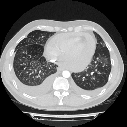 Cardiac tamponade (Radiopaedia 78607-91368 Axial lung window 66).jpg