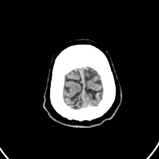 Cardioembolic stroke- ACA and MCA territories (Radiopaedia 58904-66140 Axial non-contrast 159).jpg