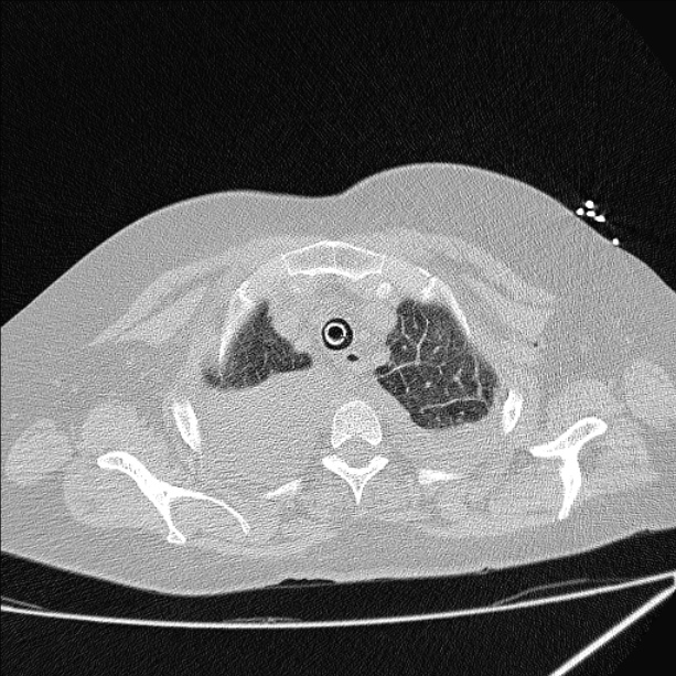 Cardiogenic pulmonary edema (Radiopaedia 29213-29609 Axial lung window 10).jpg