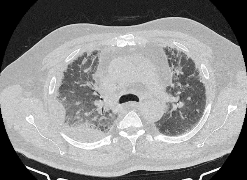 Cardiogenic pulmonary edema (Radiopaedia 68180-77678 Axial lung window 29).jpg