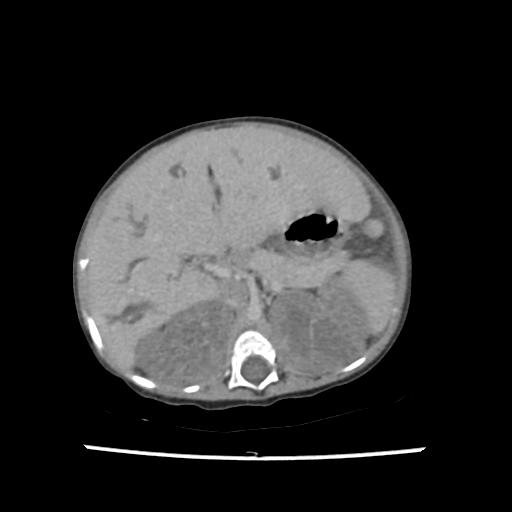 File:Caroli disease with autosomal recessive polycystic kidney disease (ARPKD) (Radiopaedia 89651-106703 B 69).jpg