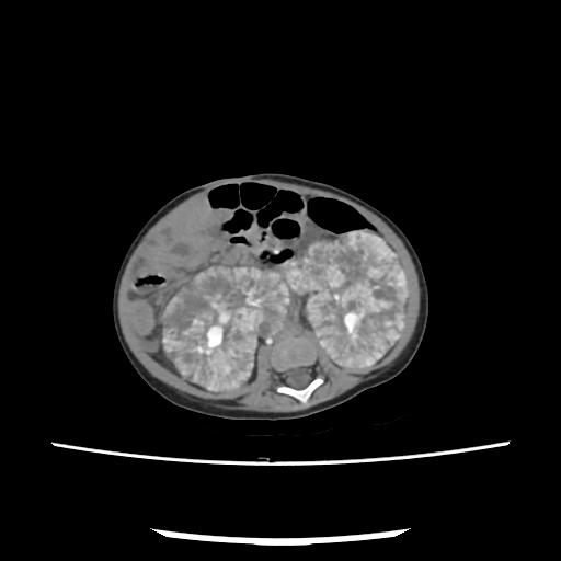 Caroli disease with autosomal recessive polycystic kidney disease (ARPKD) (Radiopaedia 89651-106703 E 139).jpg