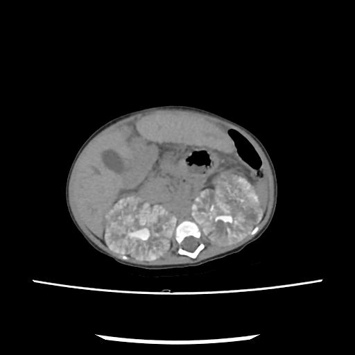 Caroli disease with autosomal recessive polycystic kidney disease (ARPKD) (Radiopaedia 89651-106703 E 98).jpg