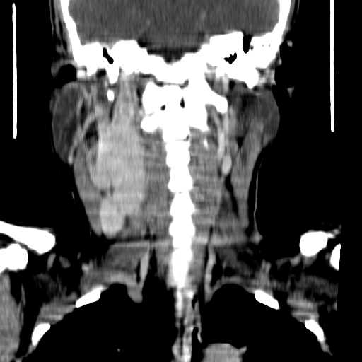 File:Carotid body tumor (Radiopaedia 27890-28124 B 7).jpg