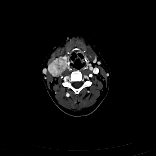 Carotid body tumor (Radiopaedia 83615-98727 D 61).jpg