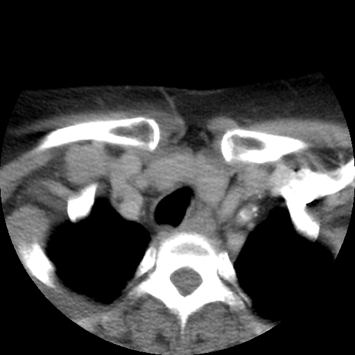 Carotid body tumor (paraganglioma) (Radiopaedia 38586-40729 A 30).jpg