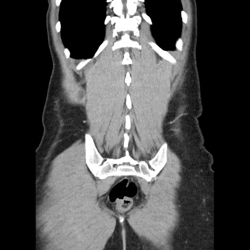 File:Castleman disease with fibrous pseudotumor in the abdomen (Radiopaedia 77296-89373 B 79).jpg