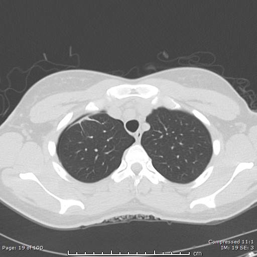 Catamenial pneumothorax (Radiopaedia 54382-60600 Axial non-contrast 19).jpg