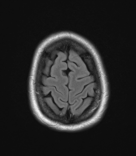 File:Cavernoma with bleed - midbrain (Radiopaedia 54546-60774 Axial FLAIR 27).png