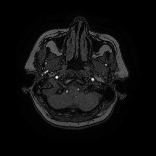 Cavernoma with developmental venous anomaly (Radiopaedia 22470-22507 MRA 93).jpg