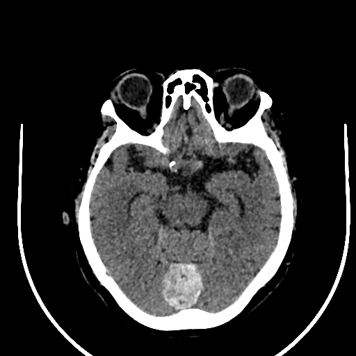 Cavernous hemangioma of the cerebellar falx (Radiopaedia 73025-83723 Axial non-contrast 53).jpg