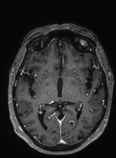 Cavernous hemangioma of the cerebellar falx (Radiopaedia 73025-83724 Axial T1 C+ 179).jpg