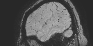 File:Cavernous hemangioma of the cerebellar falx (Radiopaedia 73025-83724 Sagittal BOLD 28).jpg