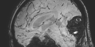 Cavernous hemangioma of the cerebellar falx (Radiopaedia 73025-83724 Sagittal BOLD 98).jpg