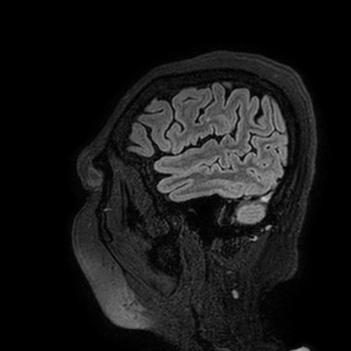 Cavernous hemangioma of the cerebellar falx (Radiopaedia 73025-83724 Sagittal FLAIR 191).jpg