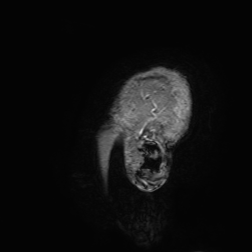 Cavernous hemangioma of the cerebellar falx (Radiopaedia 73025-83724 Sagittal T1 C+ 213).jpg