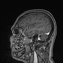 Cavernous sinus meningioma (Radiopaedia 63682-72367 Sagittal T1 C+ 52).jpg
