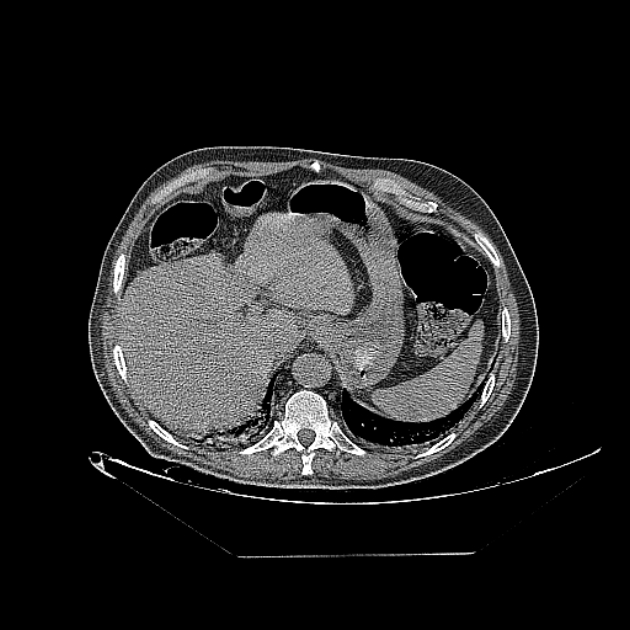 Cavitating bronchogenic carcinoma (Radiopaedia 44489-48162 Axial non-contrast 80).jpg