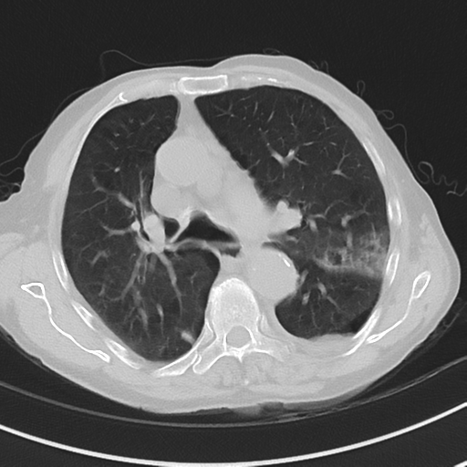 Cavitating pneumonia - lingular segments (Radiopaedia 34386-35678 Axial lung window 25).png