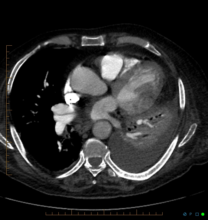 Cavitating pulmonary infarction (Radiopaedia 54634-60849 Axial C+ CTPA 46).jpg