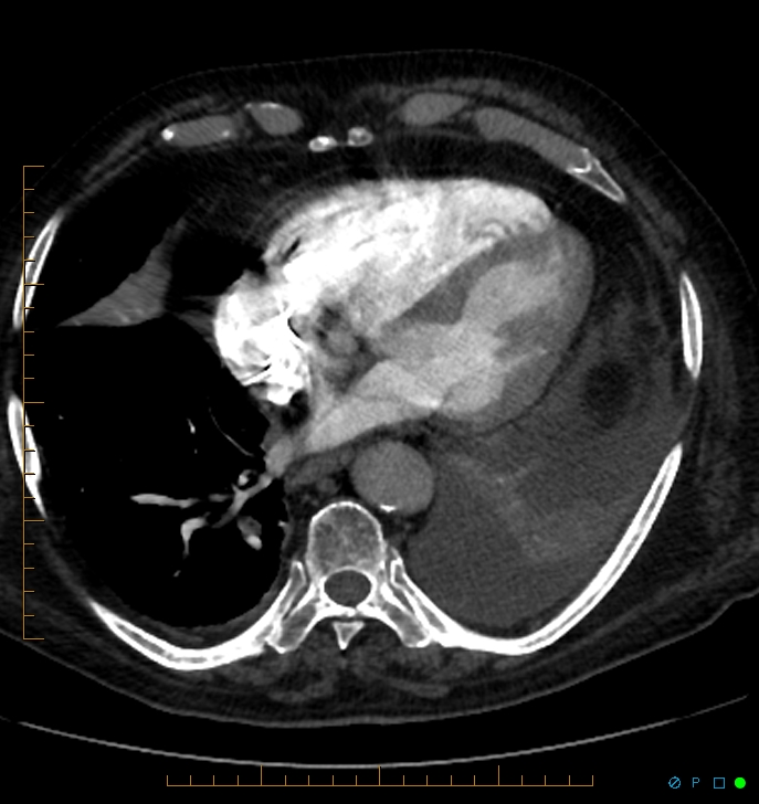 Cavitating pulmonary infarction (Radiopaedia 54634-60849 Axial C+ CTPA 59).jpg