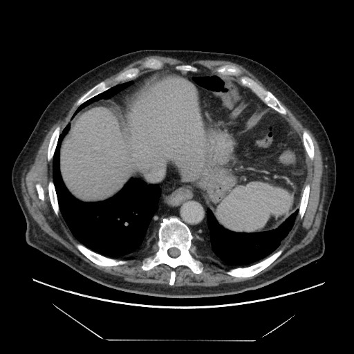 Cecal adenocarcinoma (Radiopaedia 64871-73817 A 8).jpg