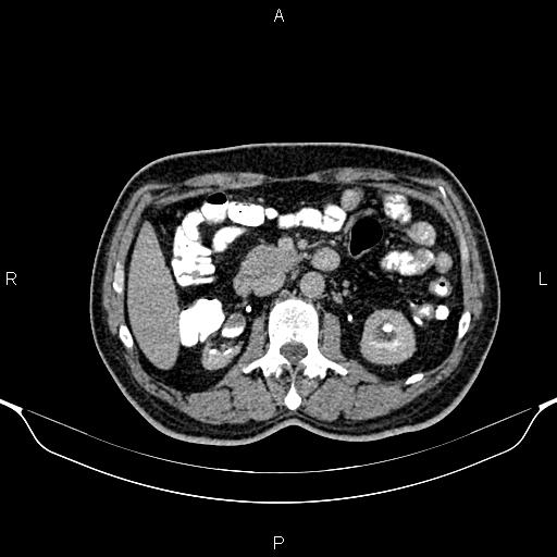 Cecal adenocarcinoma (Radiopaedia 85324-100916 Axial C+ delayed 40).jpg