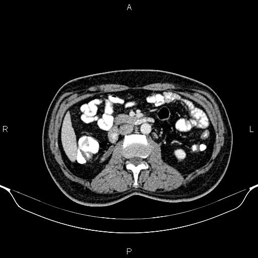 File:Cecal adenocarcinoma (Radiopaedia 85324-100916 B 43).jpg