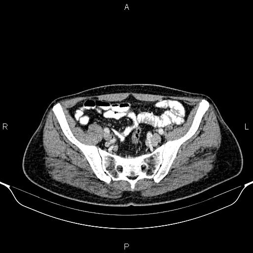 File:Cecal adenocarcinoma (Radiopaedia 85324-100916 B 77).jpg