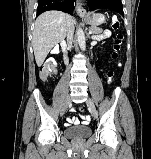 Cecal adenocarcinoma (Radiopaedia 85324-100916 D 36).jpg