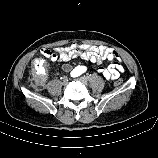File:Cecal cancer with appendiceal mucocele (Radiopaedia 91080-108651 Axial C+ delayed 51).jpg