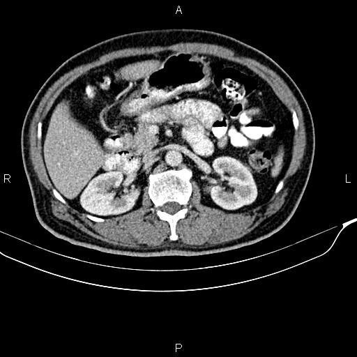 Cecal cancer with appendiceal mucocele (Radiopaedia 91080-108651 B 41).jpg