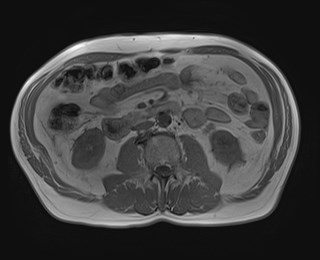 Cecal mass causing appendicitis (Radiopaedia 59207-66532 Axial T1 in-phase 70).jpg