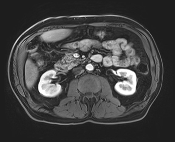 Cecal mass causing appendicitis (Radiopaedia 59207-66532 H 63).jpg