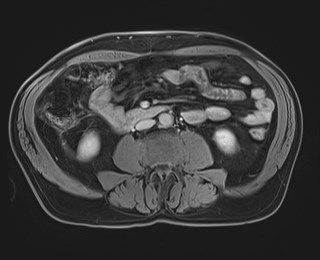 Cecal mass causing appendicitis (Radiopaedia 59207-66532 J 76).jpg