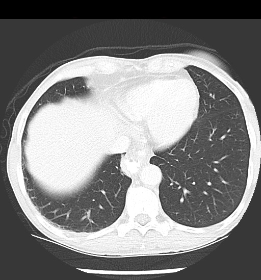 File:Cecal volvulus (Radiopaedia 48543-53513 Axial lung window 9).jpg