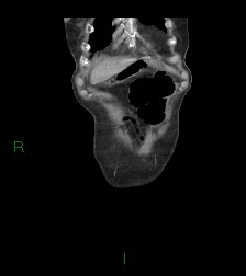 Cecal volvulus (Radiopaedia 86741-102900 B 71).jpg