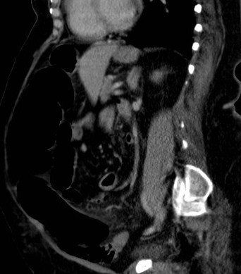 File:Celiac artery compression syndrome (Radiopaedia 24287-24570 A 9).jpg