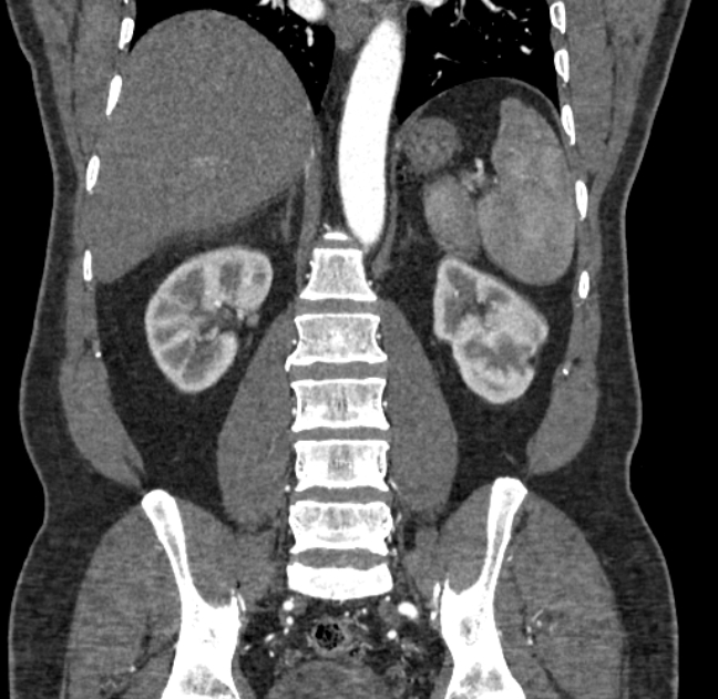 Celiac artery dissection (Radiopaedia 52194-58080 C 102).jpg
