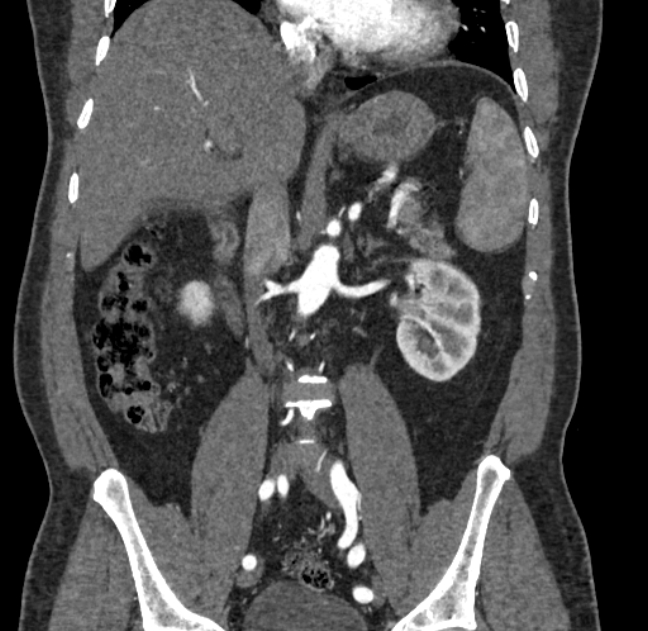 Celiac artery dissection (Radiopaedia 52194-58080 C 66).jpg