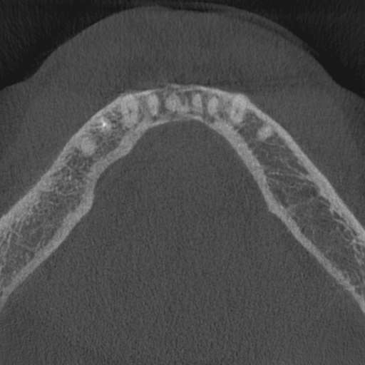 Cemento-osseous dysplasia (Radiopaedia 48251-53126 Axial non-contrast 24).jpg