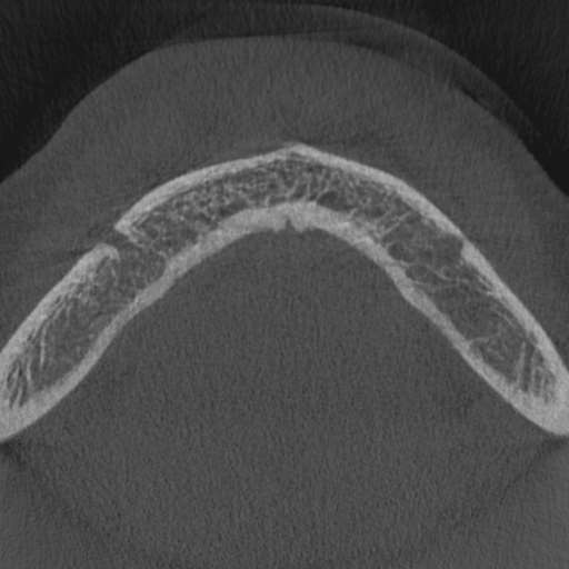 Cemento-osseous dysplasia (Radiopaedia 48251-53126 Axial non-contrast 5).jpg
