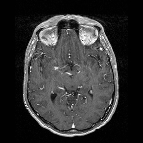 Central-variant posterior reversible encephalopathy syndrome (PRES) (Radiopaedia 43880-47358 Axial T1 C+ 70).jpg
