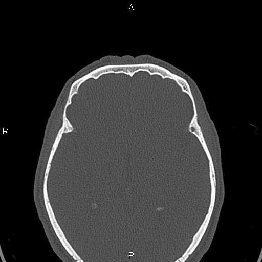 File:Central giant cell granuloma (Radiopaedia 83346-97761 Axial bone window 77).jpg