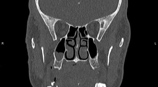 File:Central giant cell granuloma (Radiopaedia 83346-97761 Coronal bone window 17).jpg