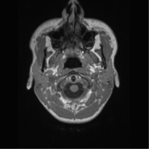 File:Central neurocytoma (Radiopaedia 37664-39557 Axial T1 2).png