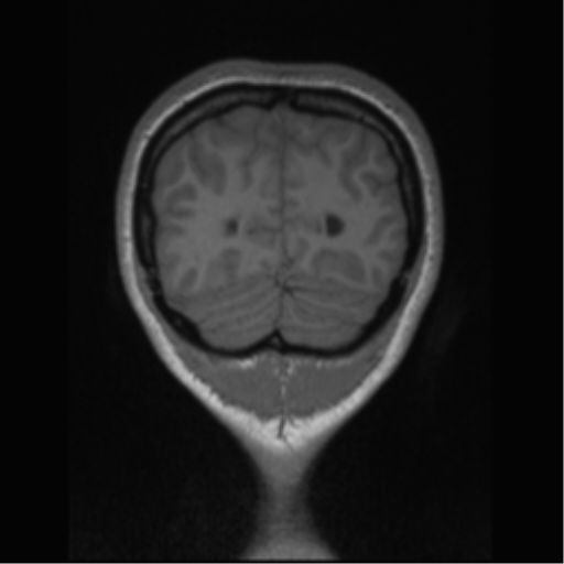 Central neurocytoma (Radiopaedia 37664-39557 Coronal T1 13).png