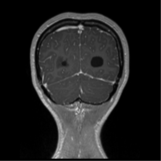 Central neurocytoma (Radiopaedia 37664-39557 Coronal T1 C+ 15).png