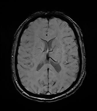 File:Central neurocytoma (Radiopaedia 71068-81303 Axial SWI 37).jpg