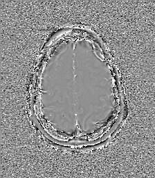 File:Central neurocytoma (Radiopaedia 84497-99872 Axial 60).jpg